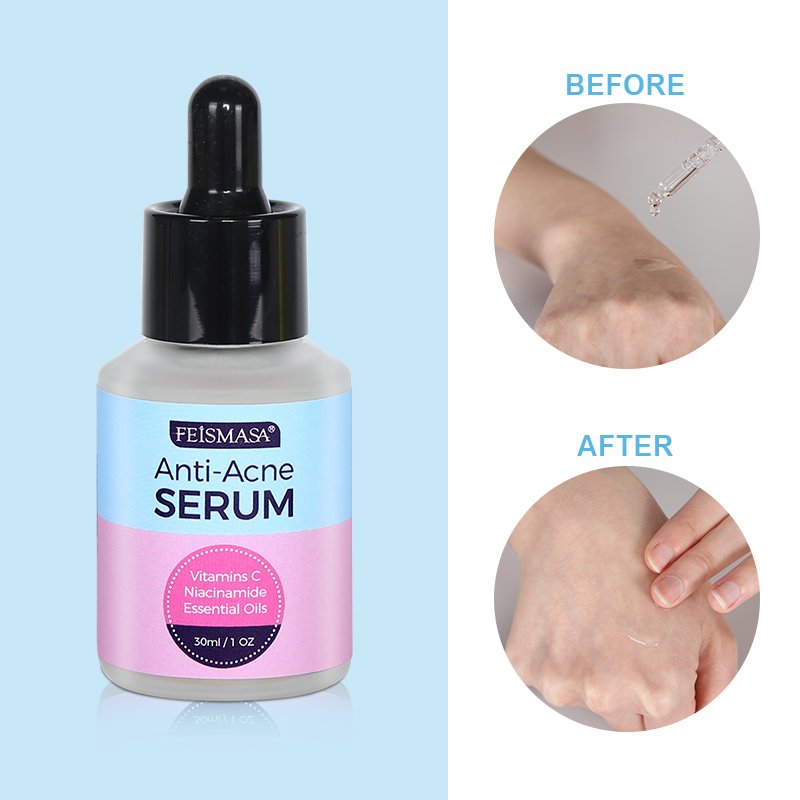 Sérum visage de traitement anti-acné et boutons - 2
